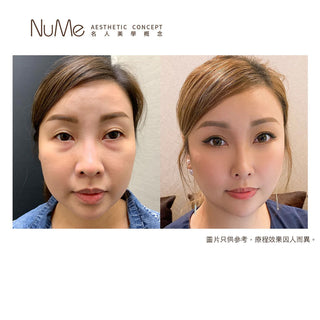 立即擺脫眼袋困擾 – 獨創棉花棒法去眼袋