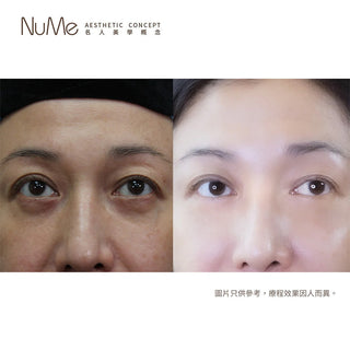 立即擺脫眼袋困擾 – 獨創棉花棒法去眼袋