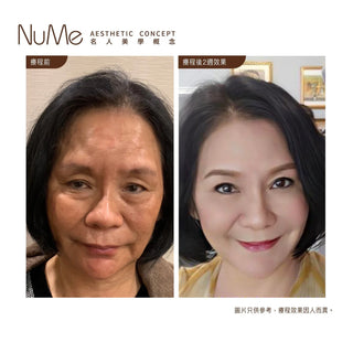 立即擺脫眼袋困擾 – 獨創棉花棒法去眼袋