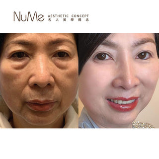 立即擺脫眼袋困擾 – 獨創棉花棒法去眼袋