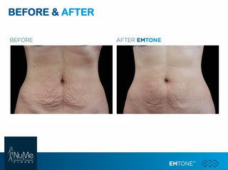 BTL Emtone 擊脂拉提