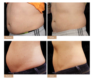 SculpSure® 非侵入性溶脂 「一次溶解24%脂肪 超越冷凍溶脂」