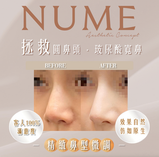 香港鼻王療程