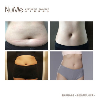 BTL Emsculpt Neo 增肌減脂