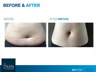 BTL Emtone 擊脂拉提