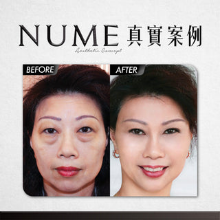 【時光無法逆轉，但眼袋可以！ DEYA 教你30分鐘解決眼袋問題】