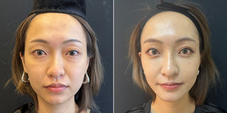 【醫生警告：90%眼袋失敗案例 都因這3大迷思！】