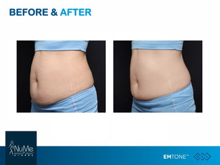 BTL Emtone 擊脂拉提
