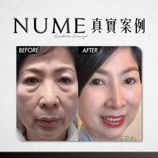 【時光無法逆轉，但眼袋可以！ DEYA 教你30分鐘解決眼袋問題】