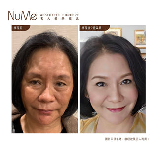 JUVÉDERM 喬雅登 美感密碼 - 自然美感輪廊