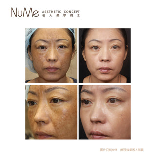 PicoSurePro 鉑金版 755蜂巢皮秒激光