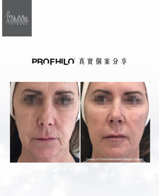 Profhilo 逆時針