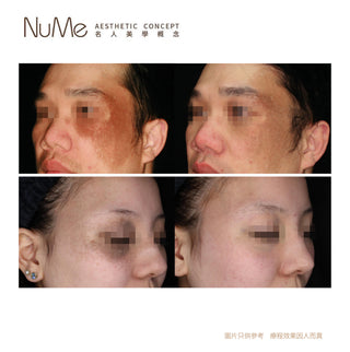 PicoSurePro 鉑金版 755蜂巢皮秒激光