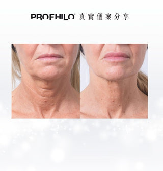 Profhilo 逆時針