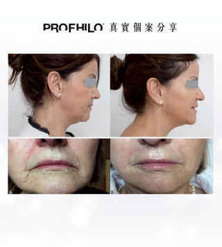 Profhilo 逆時針