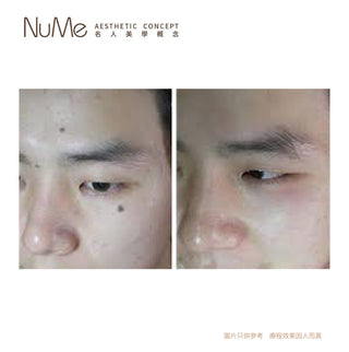 PicoSurePro 鉑金版 755蜂巢皮秒激光