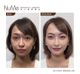 JUVÉDERM 喬雅登 美感密碼 - 自然美感輪廊