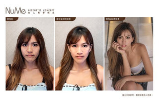 JUVÉDERM 喬雅登 美感密碼 - 自然美感輪廊