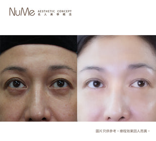 【醫生警告：90%眼袋失敗案例 都因這3大迷思！】