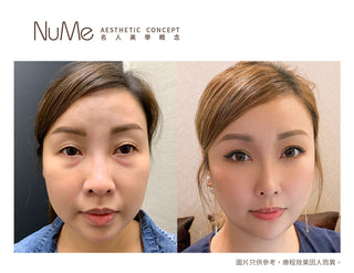 【醫生警告：90%眼袋失敗案例 都因這3大迷思！】