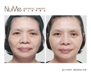 Belotero® Revive 新一代亮白保濕針