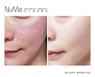 Belotero® Revive 新一代亮白保濕針