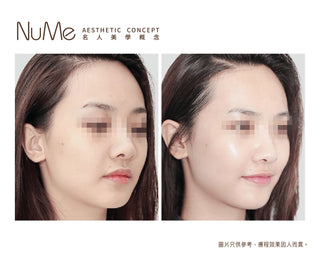 Belotero® Revive 新一代亮白保濕針