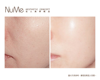 Belotero® Revive 新一代亮白保濕針