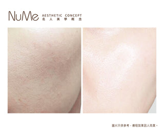 Belotero® Revive 新一代亮白保濕針