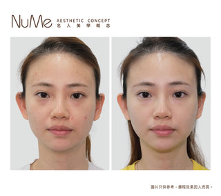 Belotero® Revive 新一代亮白保濕針