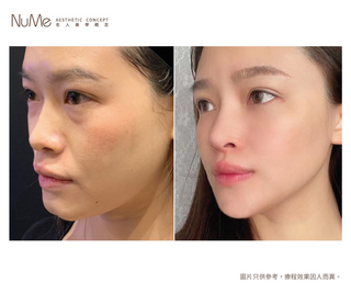 【更值得愛的顏值・鼻型是關鍵「香港鼻王」帶來最先進非入侵美鼻技術 】